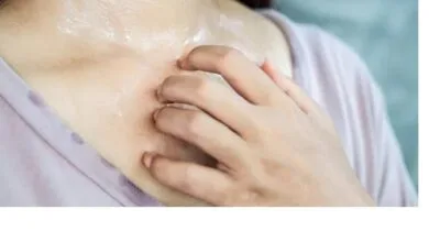 گُرگرفتگی