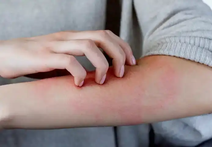 حساسیت پوستی به داروها