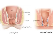 بواسیر