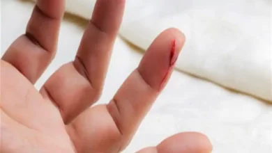 با سوختگی‌ ها و بریدگی‌ ها چه باید کرد؟