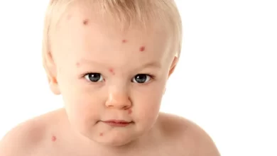 chicken pox