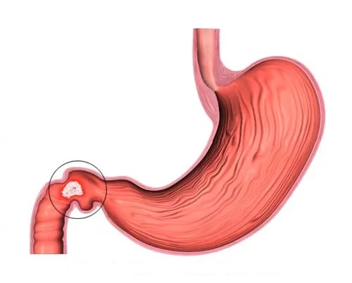 ساده‌ترین روش برای درمان زخم اثنی عشر