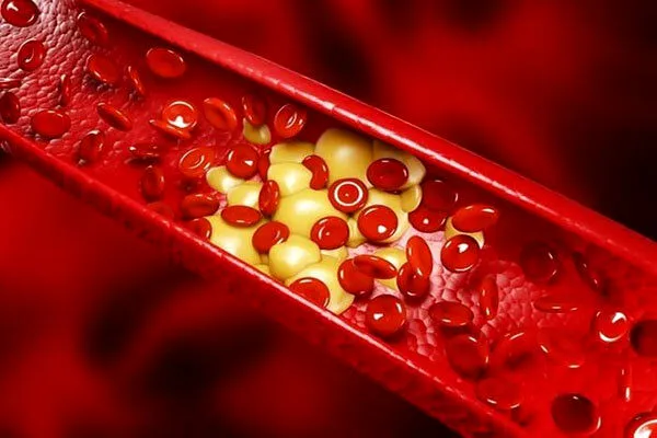 سرطان پانکراس