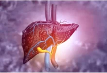 سرطان کبد
