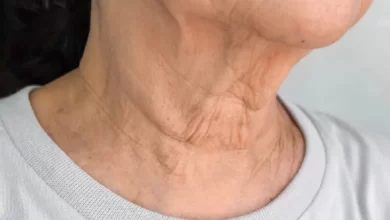 پیری پوست در ناحیه گردن