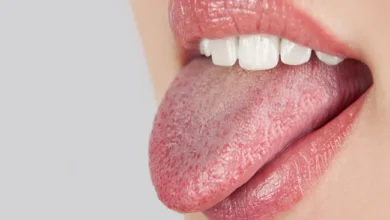علل و علائم خشکی دهان