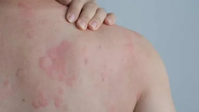 آلرژی پوستی