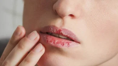 ترک خوردن لب