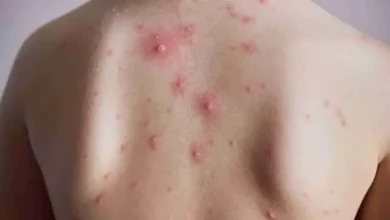آبله مرغان