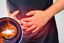 ترش کردن معده