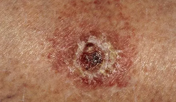 آنچه باید از سرطان پوست و ضدآفتابها بدانید1