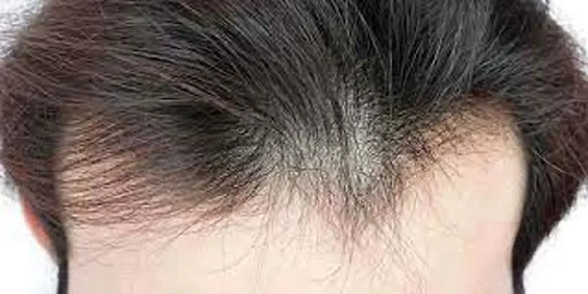 نازکشدن موها چه دلایلی میتواند داشته باشد و چه باید کرد؟