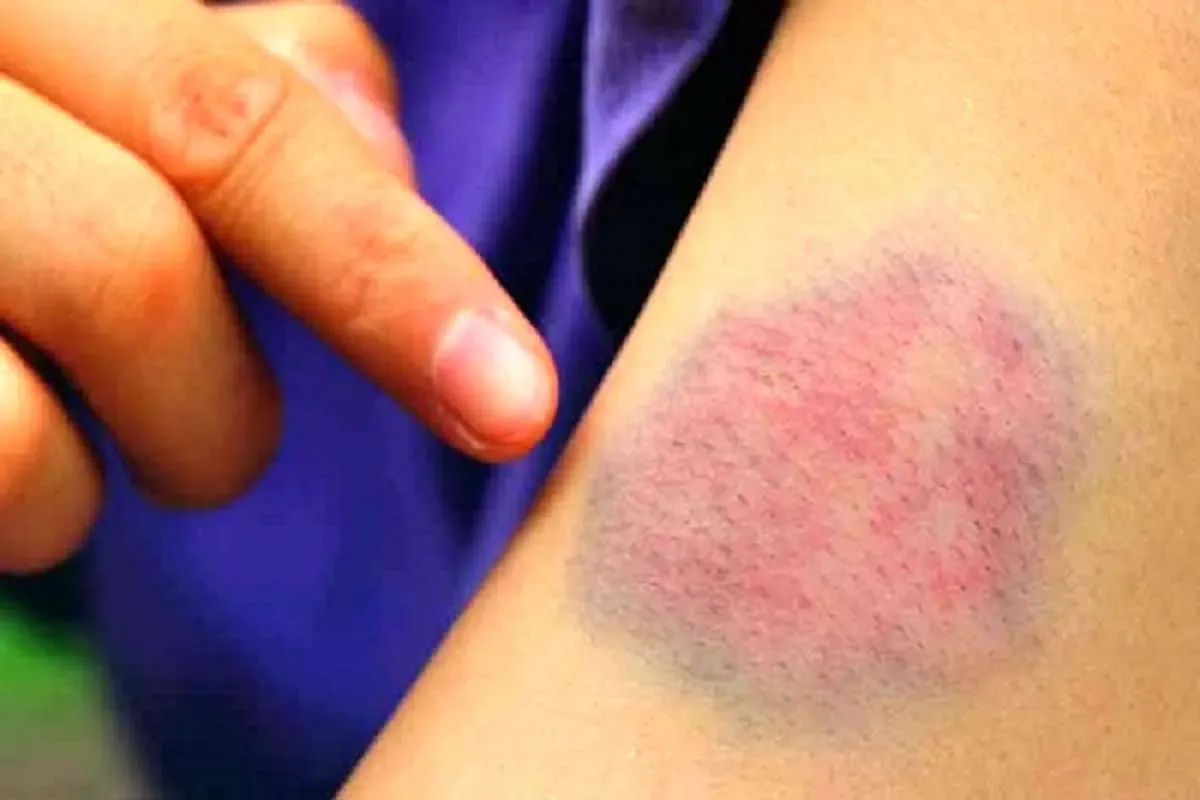 کبود شدن بدن