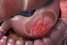 با این داروی گیاهی سرطان معده را درمان کنید2