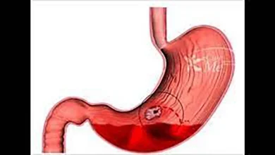 دلیل افزایش اختلالات گوارشی در تابستان چیست؟44