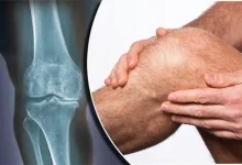 علت زانو درد در جوانی