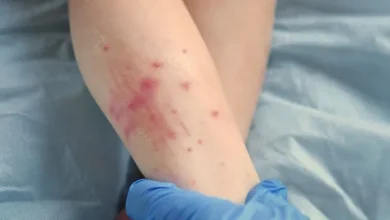 آبله میمونی 1b