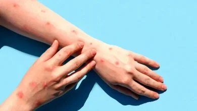 آبله میمونی