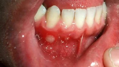 کمبود چه ویتامینی باعث آفت دهان می شود؟1