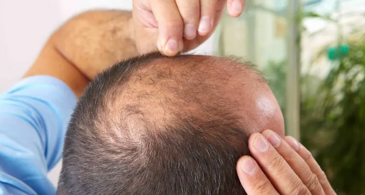 ریزش مو ارثی