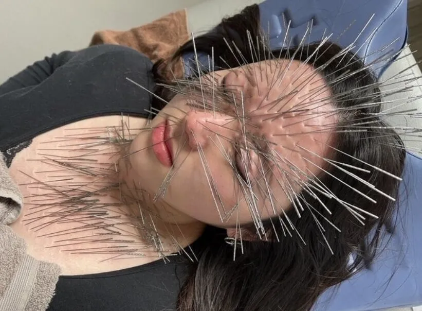طب سوزنی در ژاپن