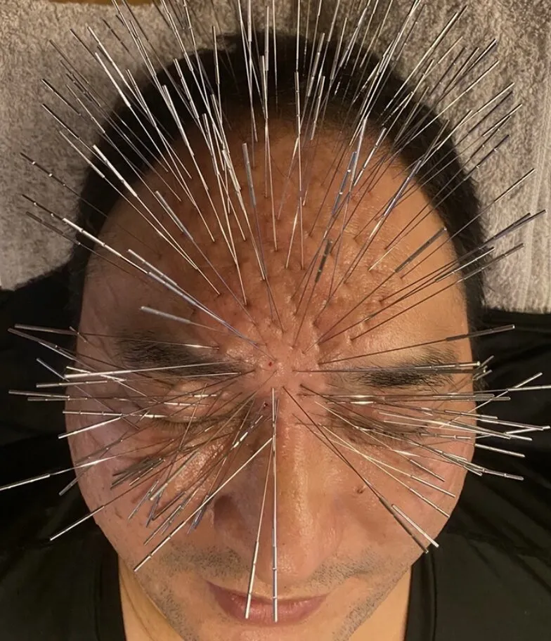 طب سوزنی در ژاپن