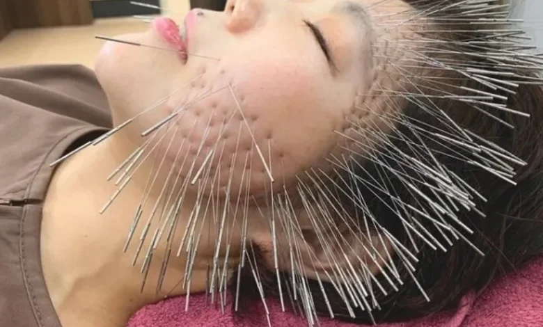 طب سوزنی در ژاپن