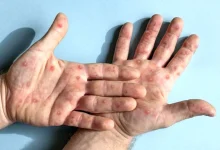 آبله میمونی