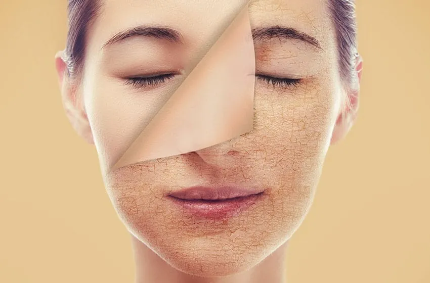 پوست دهیدراته