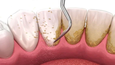 آیا جرمگیری به مینای دندان آسیب می زند؟
