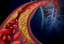 کلسترول بالا