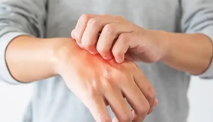خارش بدن