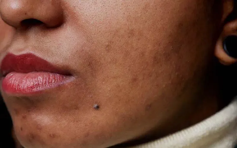 عوارض قرص ‌راکوتان