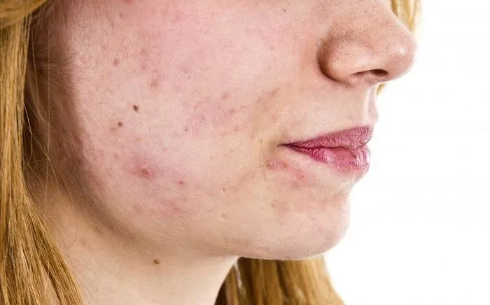 جوش هورمونی
