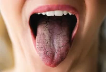 علل و علائم خشکی دهان