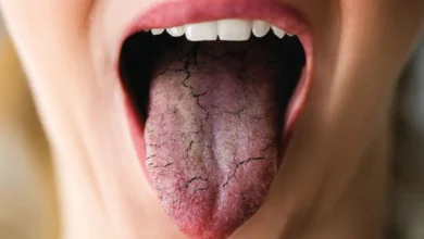 تنگی نفس