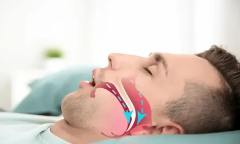 آپنه خواب