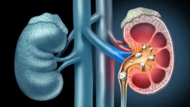 سرطان کلیه چیست؟ علل و پیشگیری