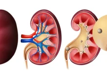 پیشگیری از چاقی پاییزه