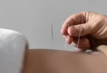 طب سوزنی در ژاپن