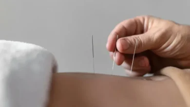 فواید طب سوزنی برای کمردرد
