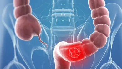تاثیر مصرف فیبر در کاهش احتمال ابتلا به سرطان روده