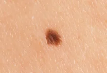 خال‌