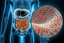 مگس زنده در روده انسان