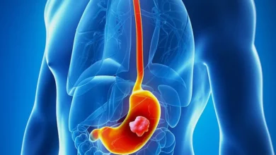 شایع‌ترین علل ایجاد زخم معده فیلم
