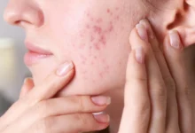 پوستهای چرب