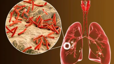 آیا بیماری سل خطرناک است؟1