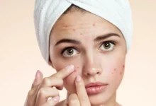 پوستهای چرب