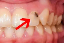 پوسیدگی دندان