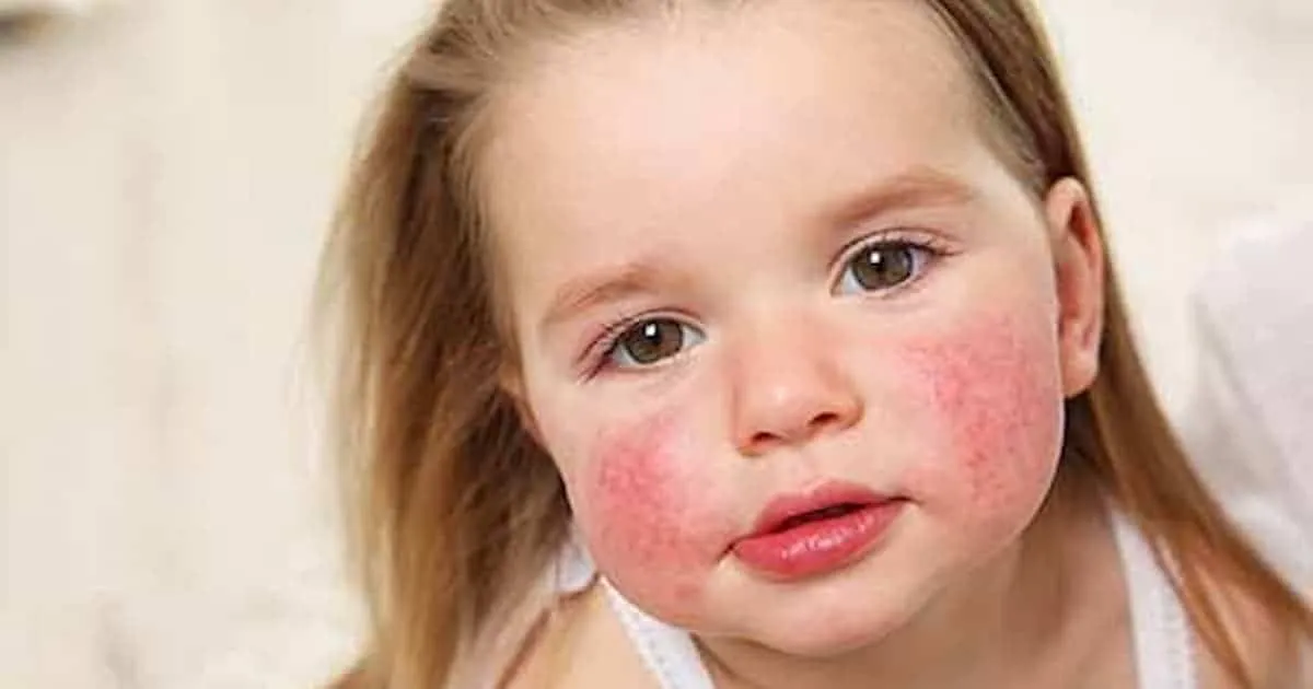 Allergy